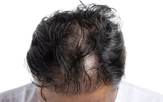 How a Natural Hair Growth Serum Can Help Combat Male Pattern Baldness